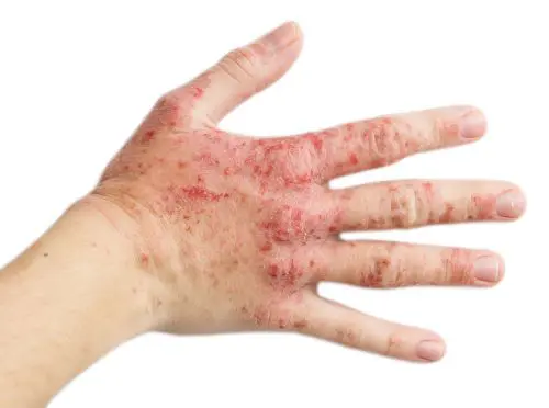 Atopisch eczeem (of: constitutioneel eczeem) op een hand